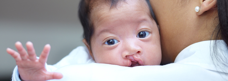 Preparing For A Baby With Cleft Lip Or Palate Ohsu